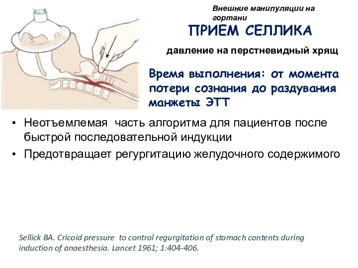 ПРИЕМ СЕЛЛИКА давление на перстневидный хрящ Неотъемлемая часть алгоритма для пациентов после