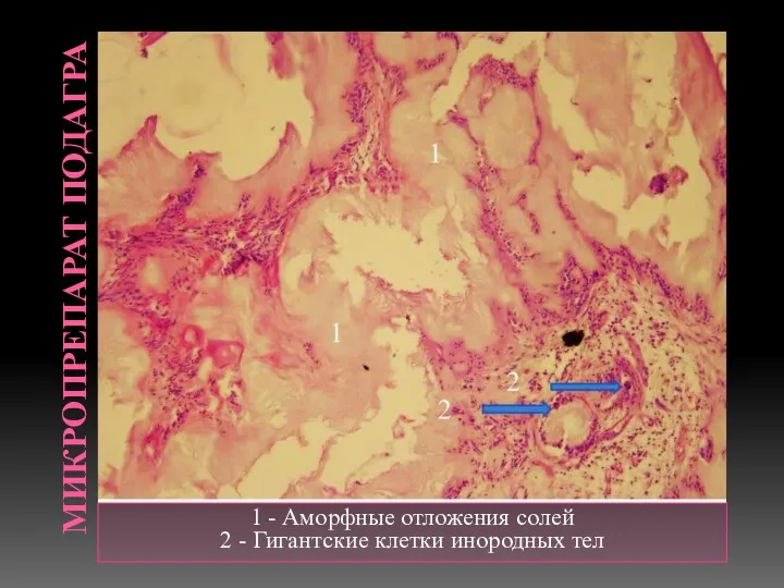 МИКРОПРЕПАРАТ ПОДАГРА 1 - Аморфные отложения солей 2 - Гигантские клетки инородных тел