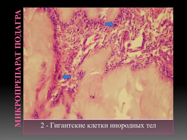 МИКРОПРЕПАРАТ ПОДАГРА 2 - Гигантские клетки инородных тел