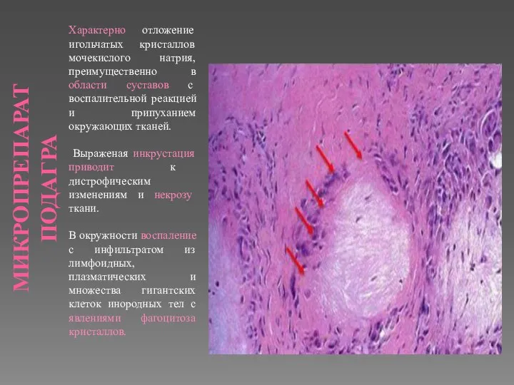 МИКРОПРЕПАРАТ ПОДАГРА Характерно отложение игольчатых кристаллов мочекислого натрия, преимущественно в области суставов