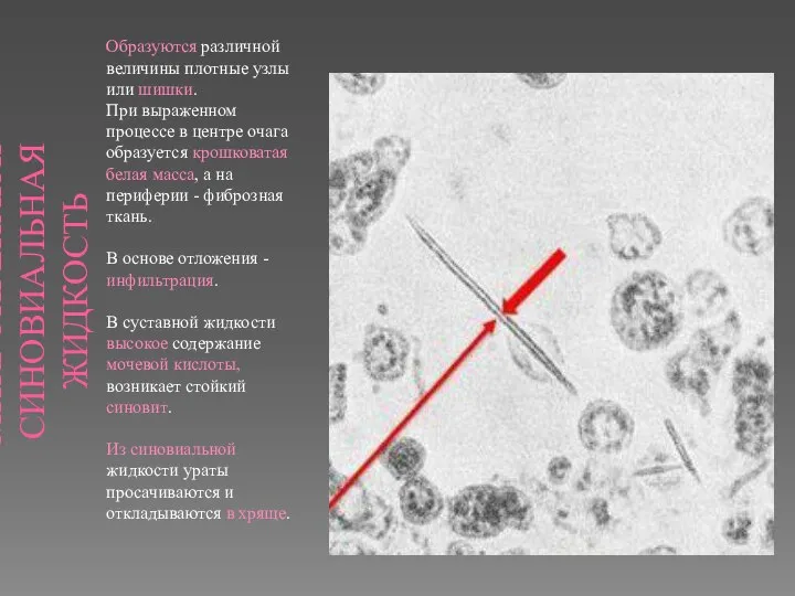 МИКРОПРЕПАРАТ СИНОВИАЛЬНАЯ ЖИДКОСТЬ Образуются различной величины плотные узлы или шишки. При выраженном