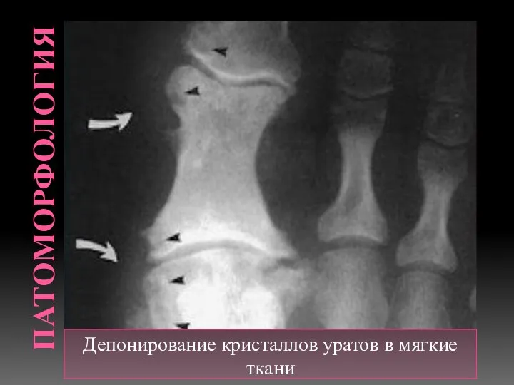 ПАТОМОРФОЛОГИЯ Депонирование кристаллов уратов в мягкие ткани