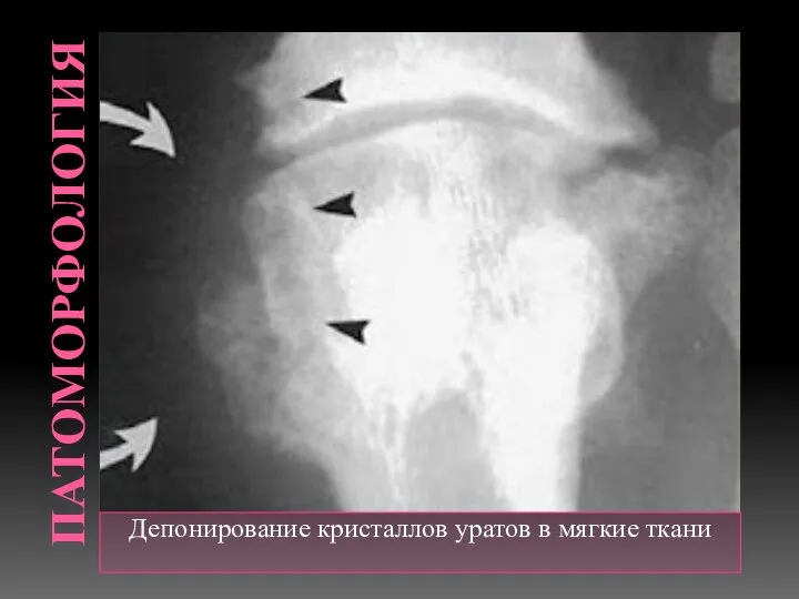 ПАТОМОРФОЛОГИЯ Депонирование кристаллов уратов в мягкие ткани