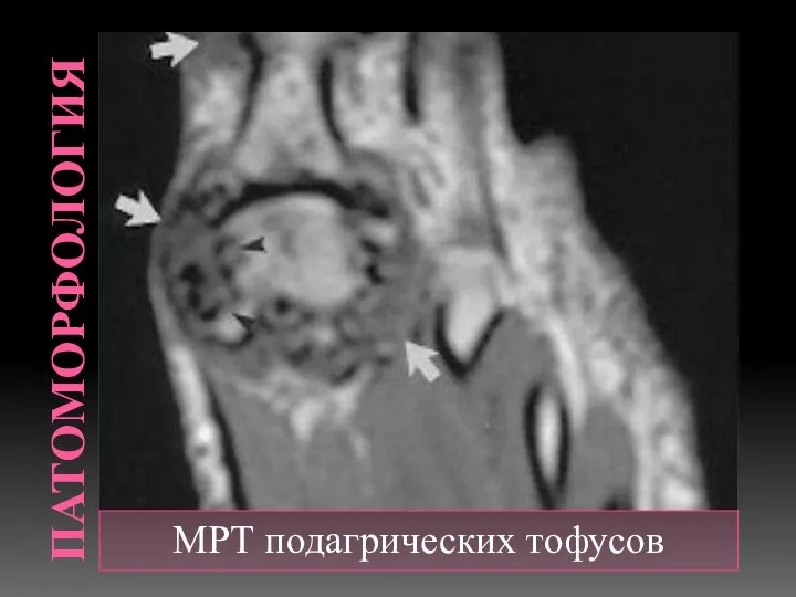 ПАТОМОРФОЛОГИЯ МРТ подагрических тофусов