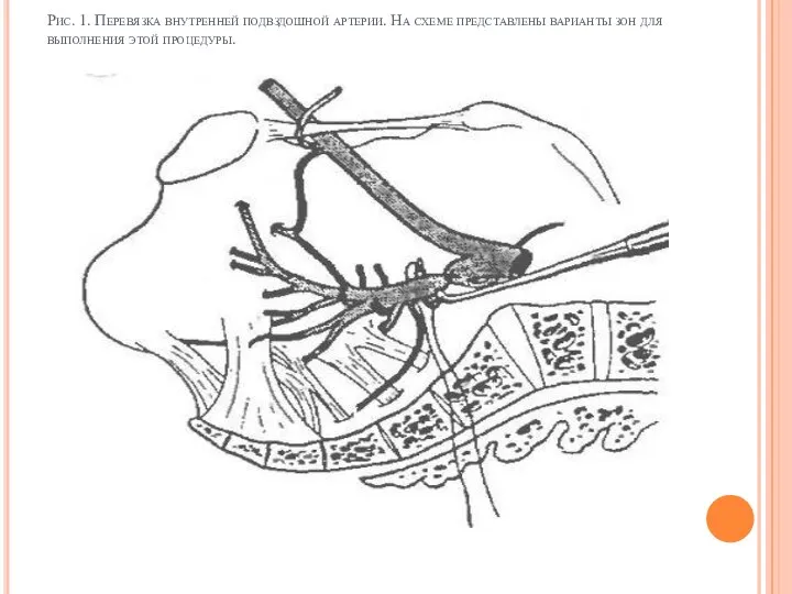 Рис. 1. Перевязка внутренней подвздошной артерии. На схеме представлены варианты зон для выполнения этой процедуры.