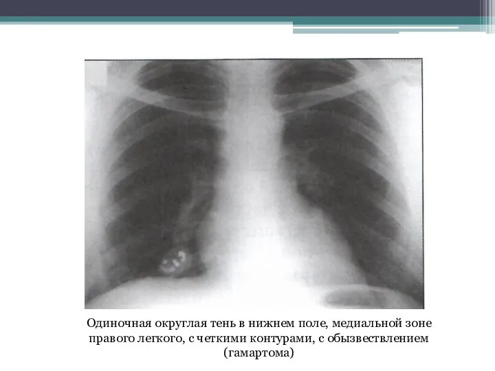 Одиночная округлая тень в нижнем поле, медиальной зоне правого легкого, с четкими контурами, с обызвествлением (гамартома)