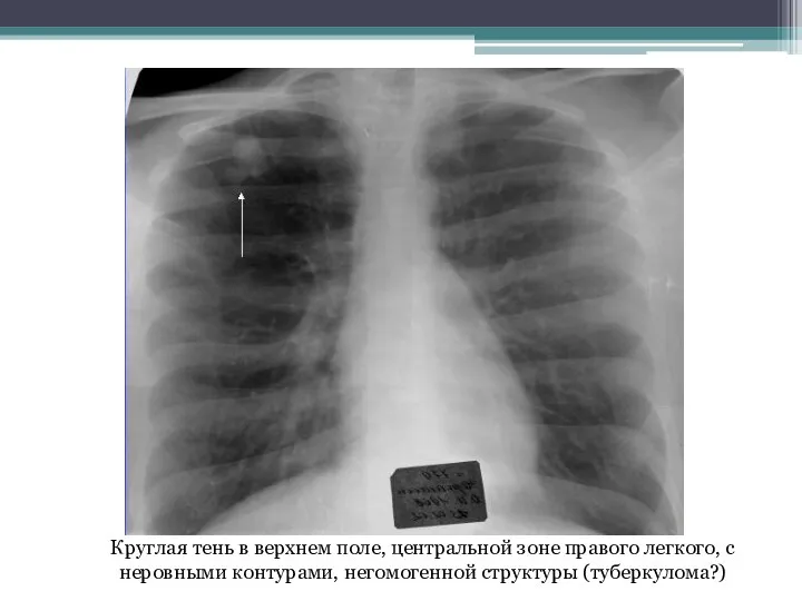 Круглая тень в верхнем поле, центральной зоне правого легкого, с неровными контурами, негомогенной структуры (туберкулома?)