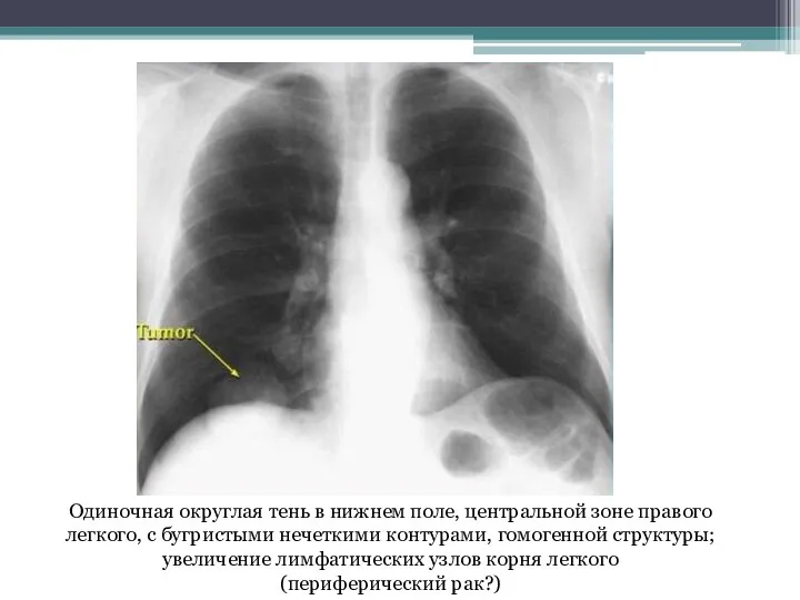 Одиночная округлая тень в нижнем поле, центральной зоне правого легкого, с бугристыми