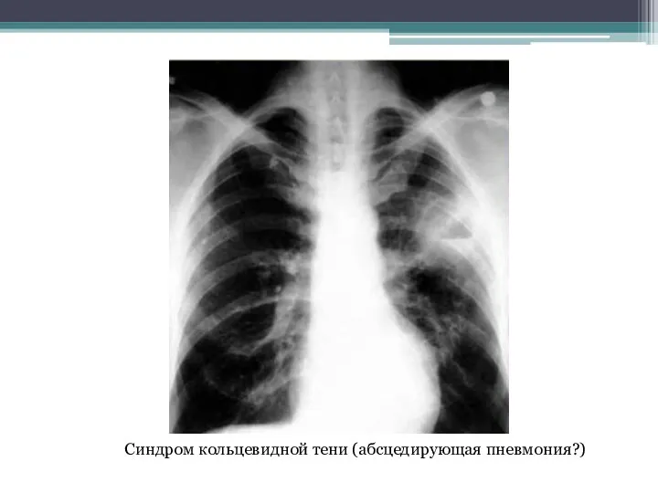 Синдром кольцевидной тени (абсцедирующая пневмония?)