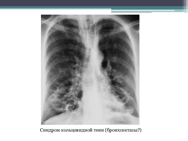 Синдром кольцевидной тени (бронхоэктазы?)