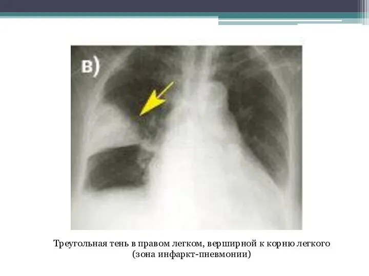 Треугольная тень в правом легком, верширной к корню легкого (зона инфаркт-пневмонии)