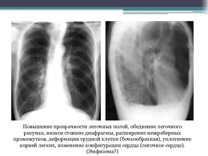 Повышение прозрачности легочных полей, обеднение легочного рисунка, низкое стояние диафрагмы, расширение межреберных