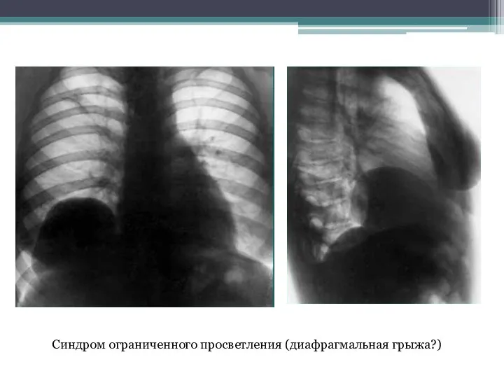 Синдром ограниченного просветления (диафрагмальная грыжа?)