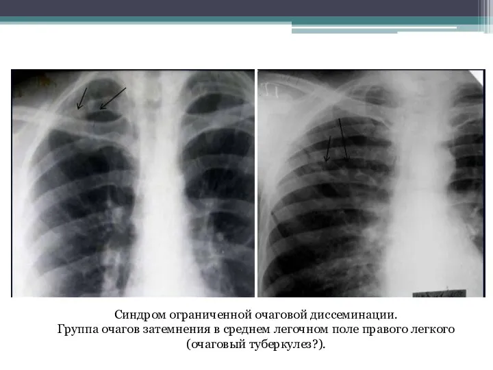 Синдром ограниченной очаговой диссеминации. Группа очагов затемнения в среднем легочном поле правого легкого (очаговый туберкулез?).