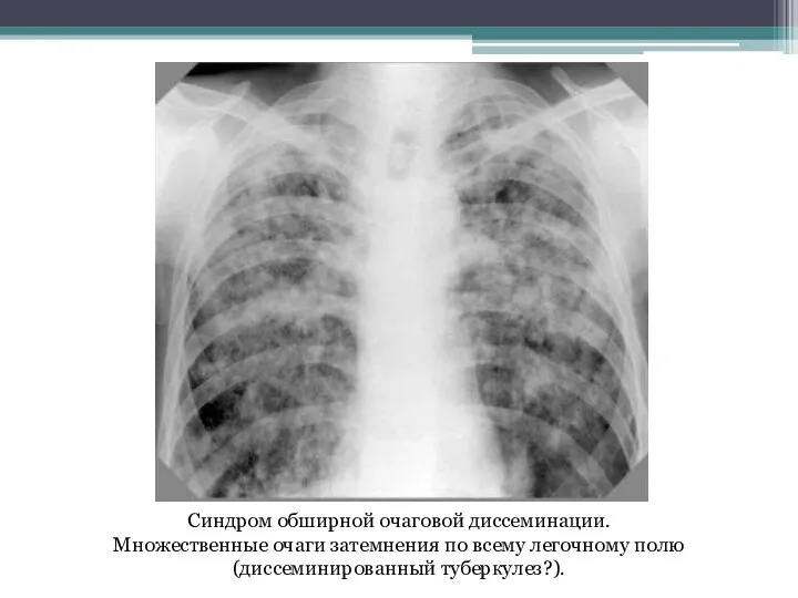 Синдром обширной очаговой диссеминации. Множественные очаги затемнения по всему легочному полю (диссеминированный туберкулез?).