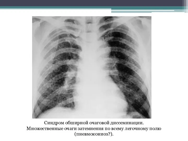 Синдром обширной очаговой диссеминации. Множественные очаги затемнения по всему легочному полю (пневмокониоз?).