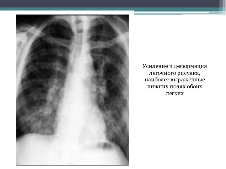 Усиление и деформация легочного рисунка, наиболее выраженные нижних полях обоих легких