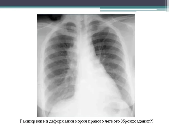 Расширение и деформация корня правого легкого (бронхоаденит?)