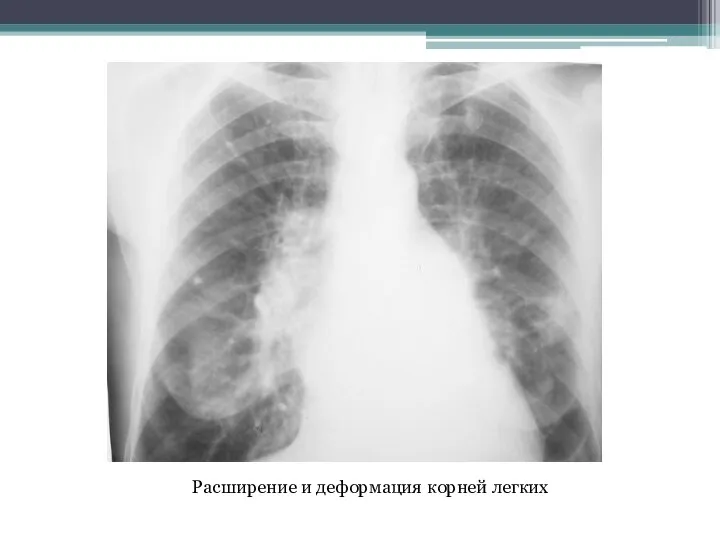 Расширение и деформация корней легких