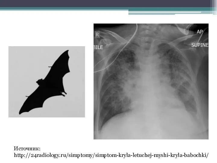 Источник: http://24radiology.ru/simptomy/simptom-kryla-letuchej-myshi-kryla-babochki/