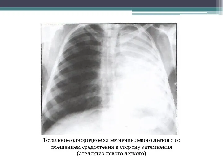 Тотальное однородное затемнение левого легкого со смещением средостения в сторону затемнения (ателектаз левого легкого)