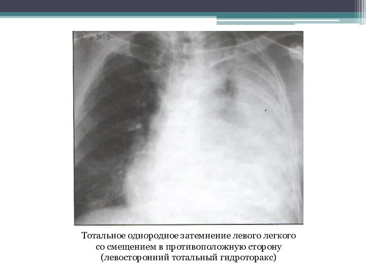 Тотальное однородное затемнение левого легкого со смещением в противоположную сторону (левосторонний тотальный гидроторакс)
