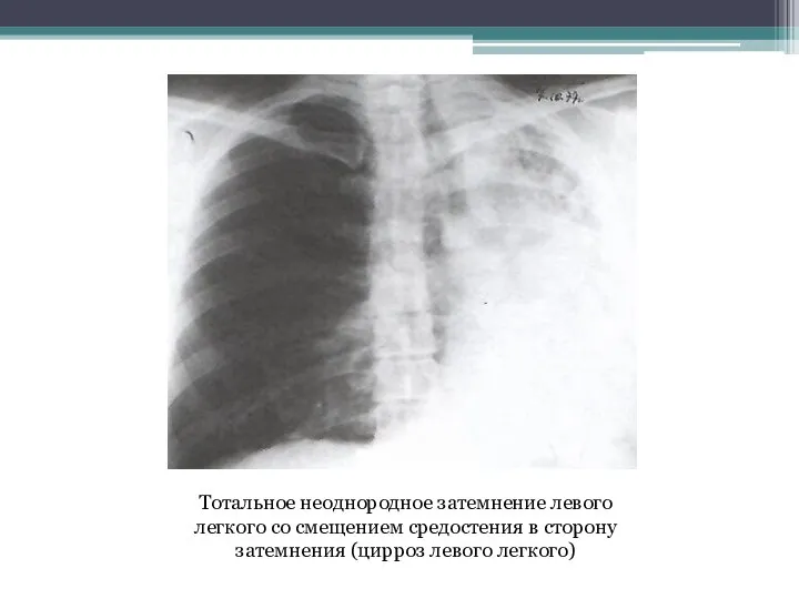 Тотальное неоднородное затемнение левого легкого со смещением средостения в сторону затемнения (цирроз левого легкого)