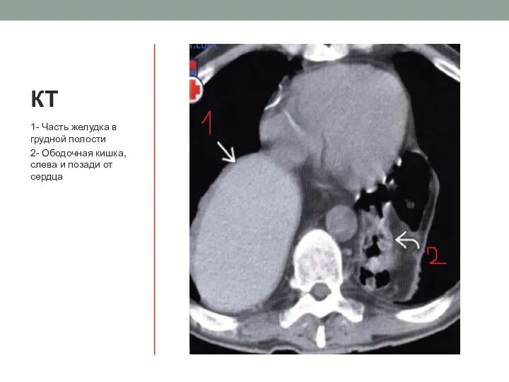 КТ 1- Часть желудка в грудной полости 2- Ободочная кишка, слева и позади от сердца