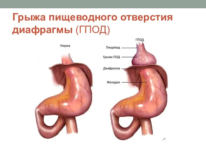 Грыжа пищеводного отверстия диафрагмы (ГПОД)