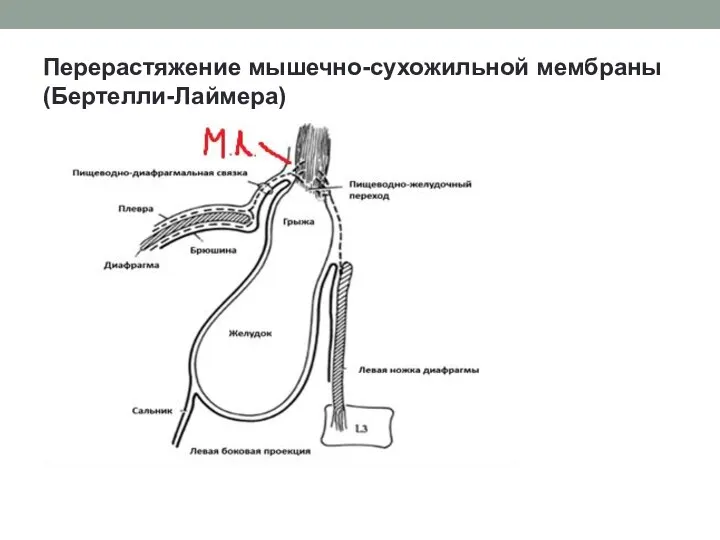 Перерастяжение мышечно-сухожильной мембраны (Бертелли-Лаймера)
