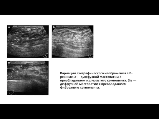 Вариации эхографического изображения в В-режиме. a — диффузной мастопатии с преобладанием железистого