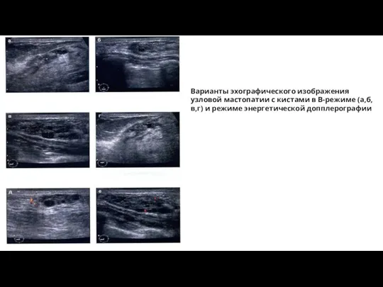 Варианты эхографического изображения узловой мастопатии с кистами в В-режиме (а,б,в,г) и режиме энергетической допплерографии