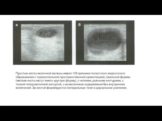 Простые кисты молочной железы имеют УЗ-признаки полостного жидкостного образования с горизонтальной пространственной