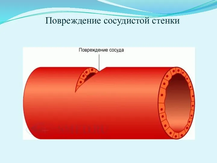 Повреждение сосудистой стенки