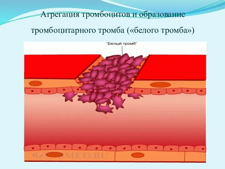 Агрегация тромбоцитов и образование тромбоцитарного тромба («белого тромба»)