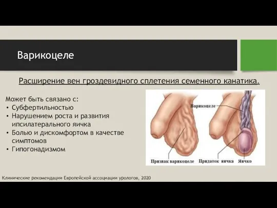 Варикоцеле Расширение вен гроздевидного сплетения семенного канатика. Может быть связано с: Субфертильностью