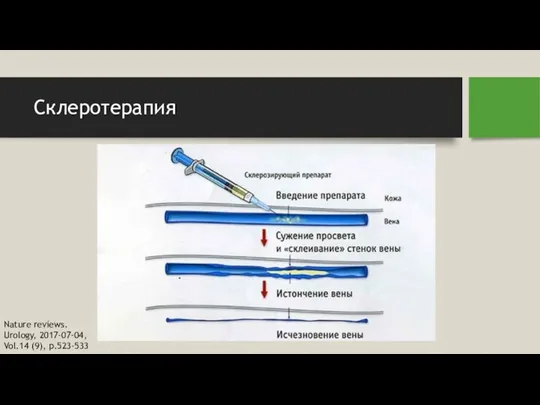 Склеротерапия Nature reviews. Urology, 2017-07-04, Vol.14 (9), p.523-533