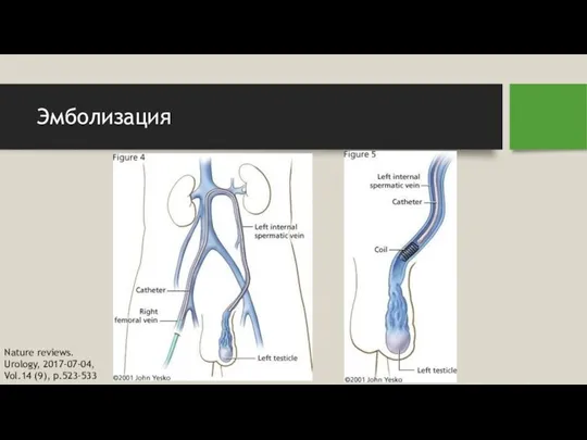 Эмболизация Nature reviews. Urology, 2017-07-04, Vol.14 (9), p.523-533