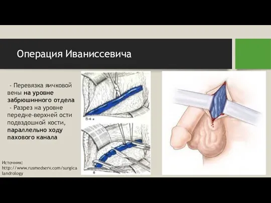Операция Иваниссевича - Перевязка яичковой вены на уровне забрюшинного отдела - Разрез
