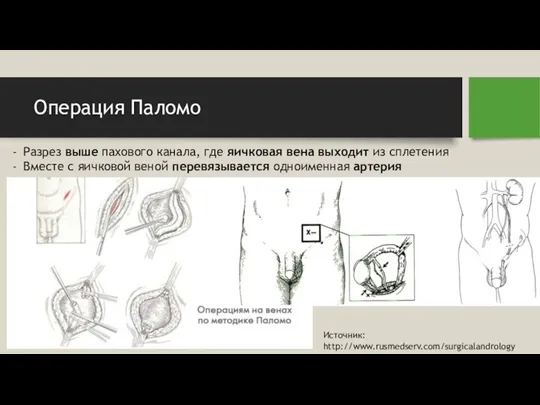 Операция Паломо Разрез выше пахового канала, где яичковая вена выходит из сплетения