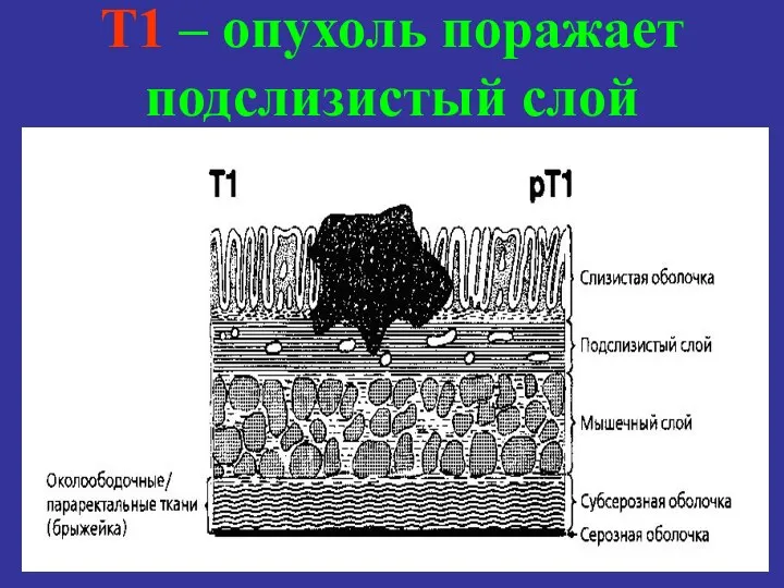 T1 – опухоль поражает подслизистый слой