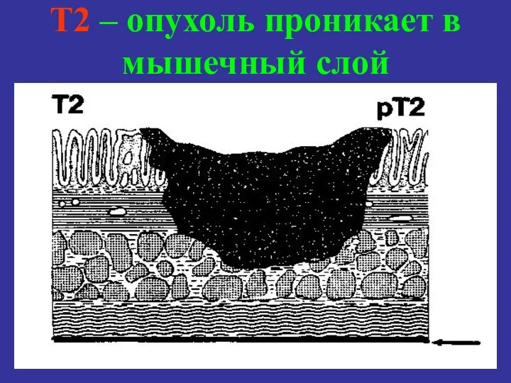 T2 – опухоль проникает в мышечный слой