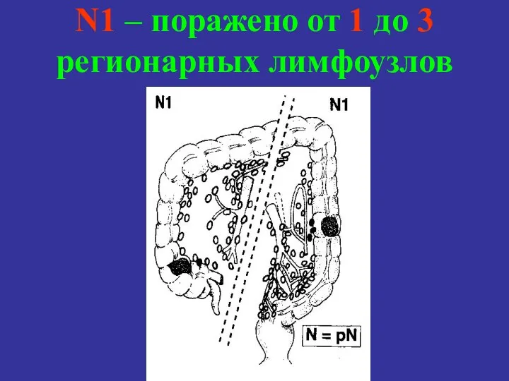 N1 – поражено от 1 до 3 регионарных лимфоузлов