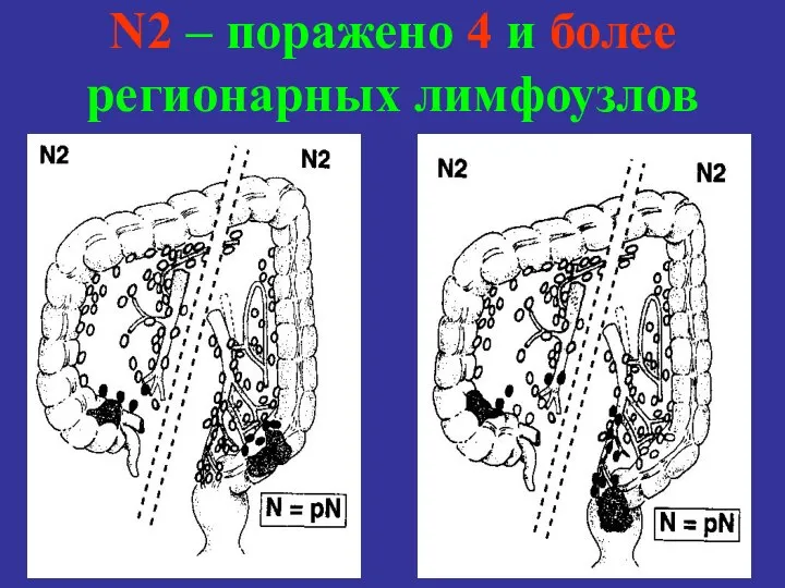 N2 – поражено 4 и более регионарных лимфоузлов