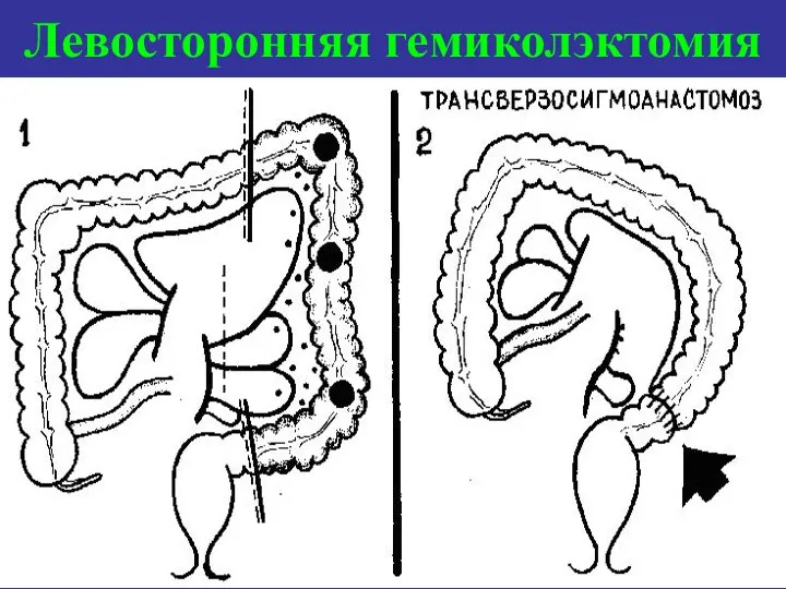 Левосторонняя гемиколэктомия