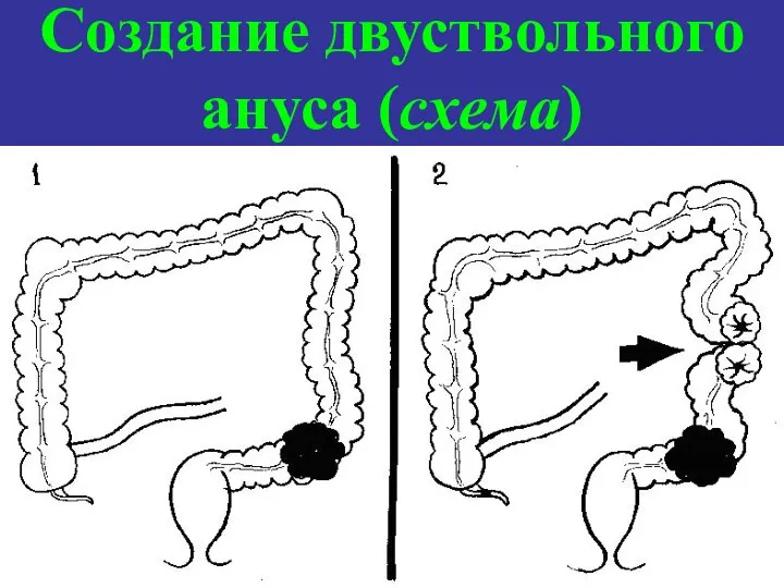Создание двуствольного ануса (схема)