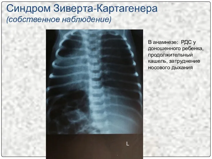 Синдром Зиверта-Картагенера (собственное наблюдение) В анамнезе: РДС у доношенного ребенка, продолжительный кашель, затруднение носового дыхания