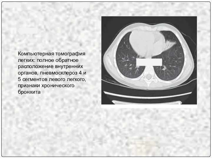 Компьютерная томография легких: полное обратное расположение внутренних органов, пневмосклероз 4 и 5