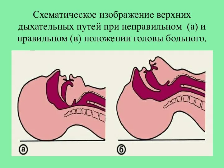 Схематическое изображение верхних дыхательных путей при неправильном (а) и правильном (в) положении головы больного.