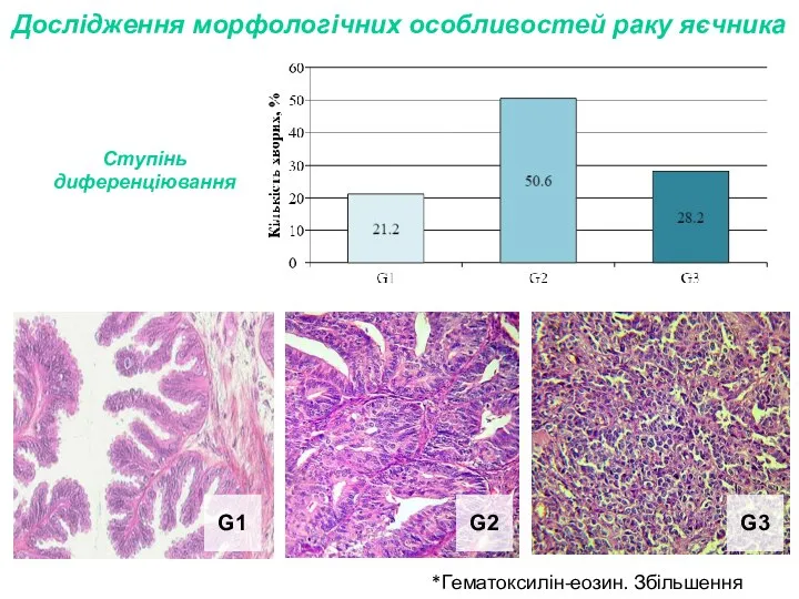Дослідження морфологічних особливостей раку яєчника *Гематоксилін-еозин. Збільшення ×200. G1 G2 G3 Ступінь диференціювання